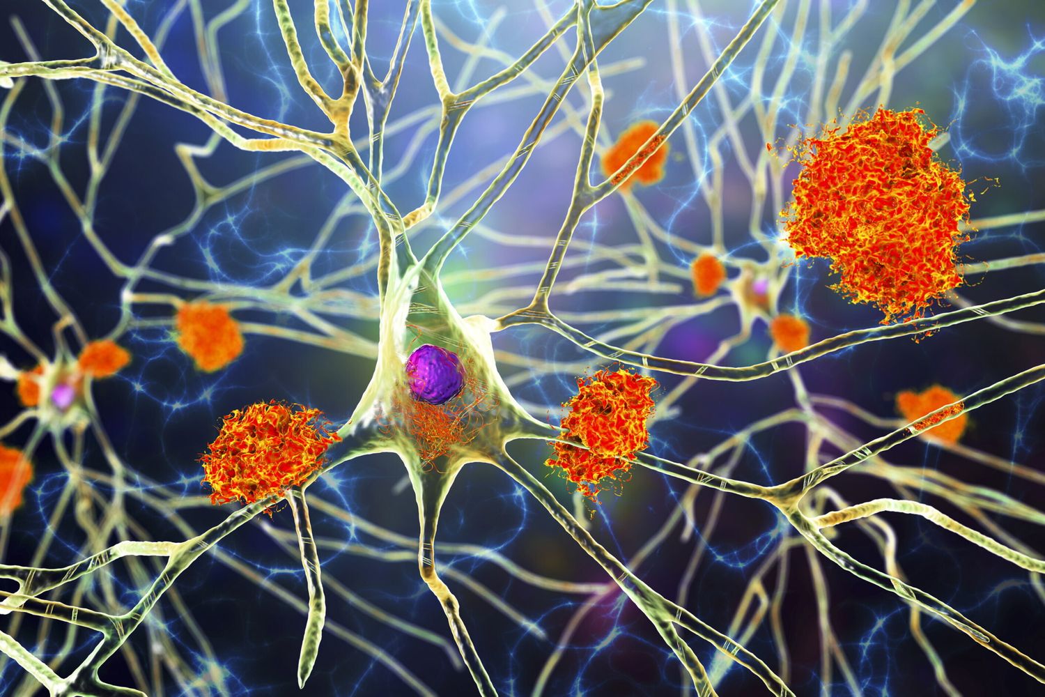 Alzheimer