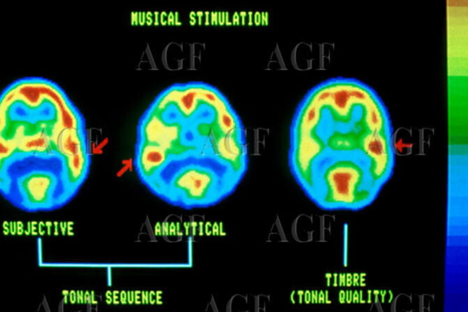 La stimolazione del cervello attraverso la musica