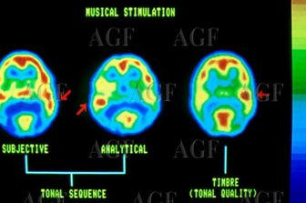 La stimolazione del cervello attraverso la musica