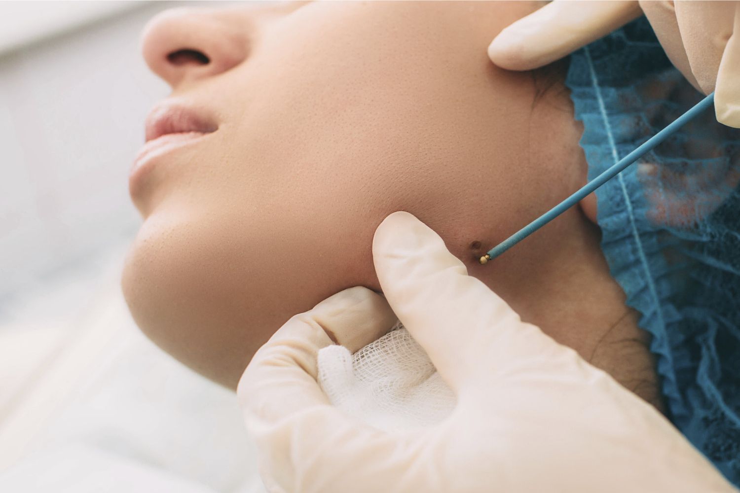 Melanoma