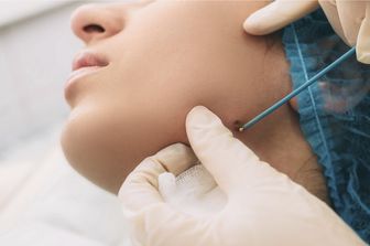 Melanoma