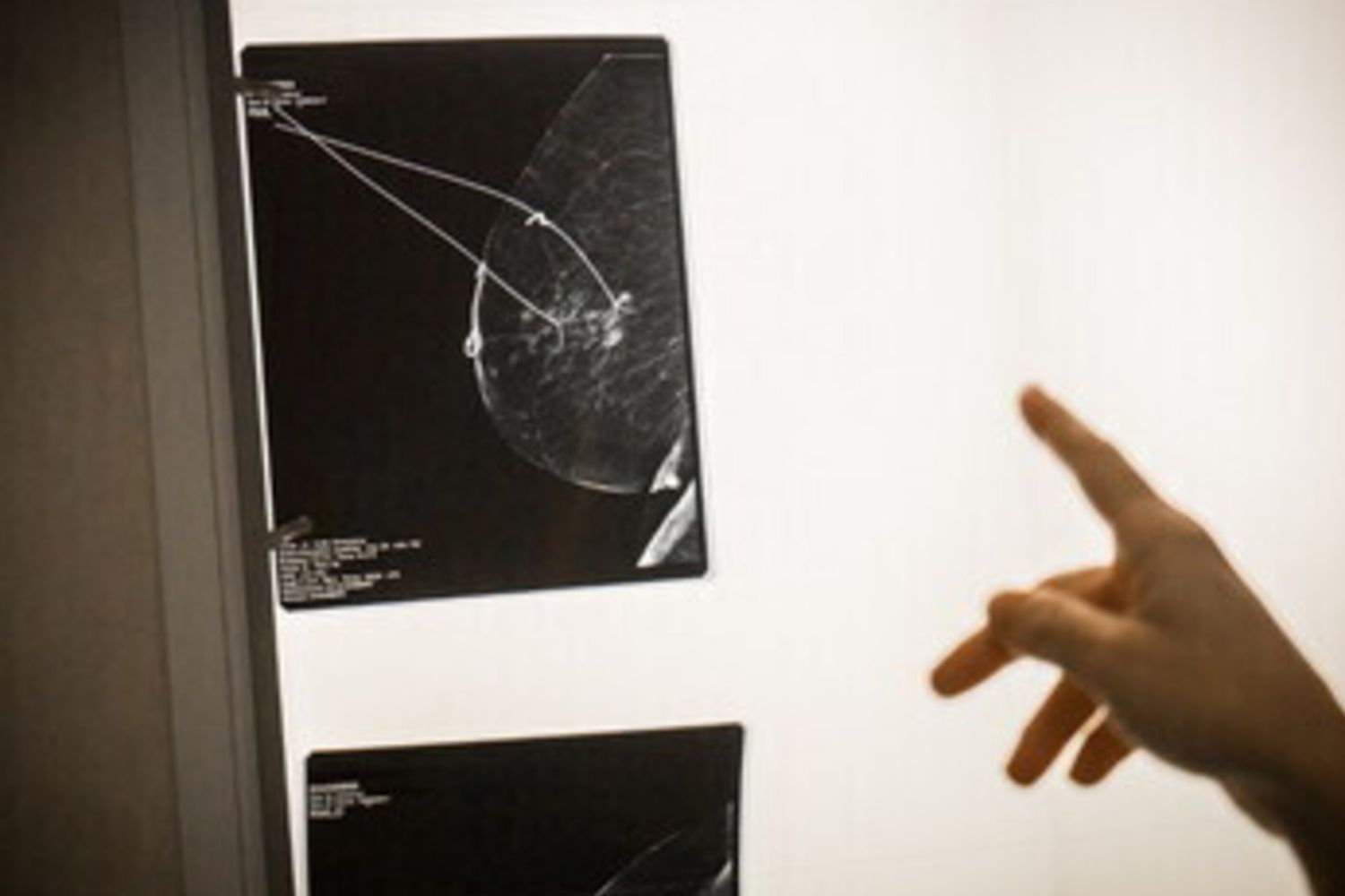 Donna scopre di avere un tumore al seno, l'unica spia era il cattivo odore