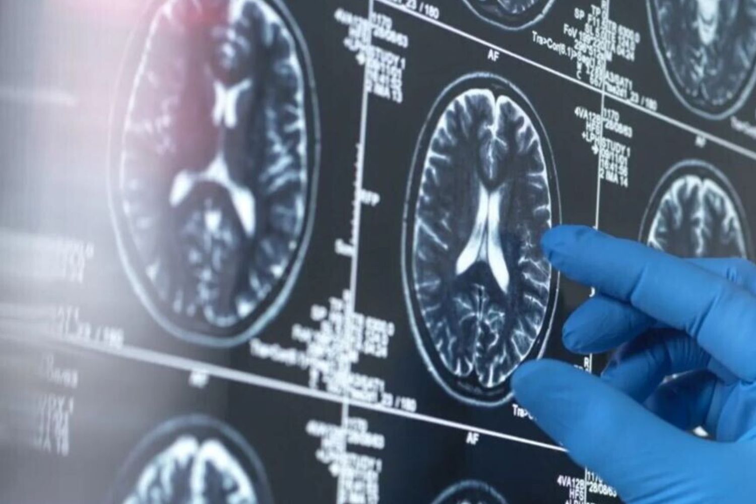 Alzheimer