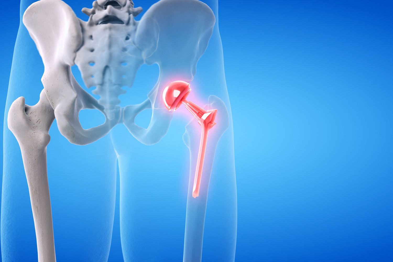 Protesi dell'anca&nbsp;