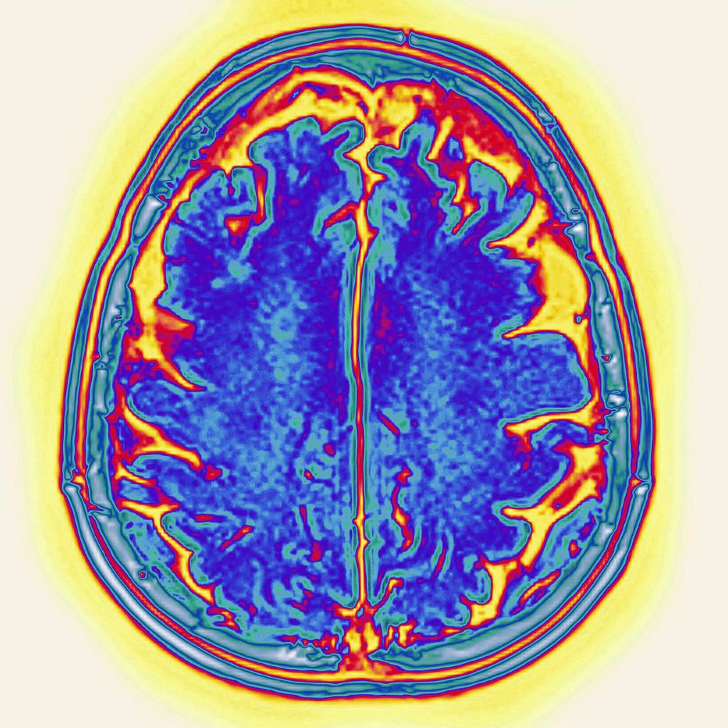 Morbo di&nbsp;Alzheimer