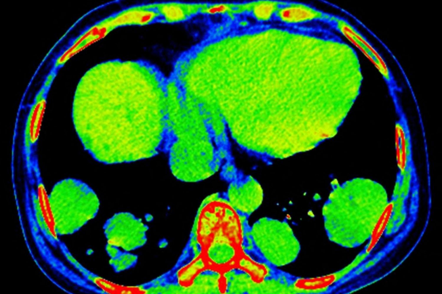 Tessuto metastatico&nbsp;