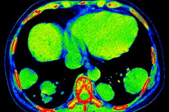 Tessuto metastatico&nbsp;