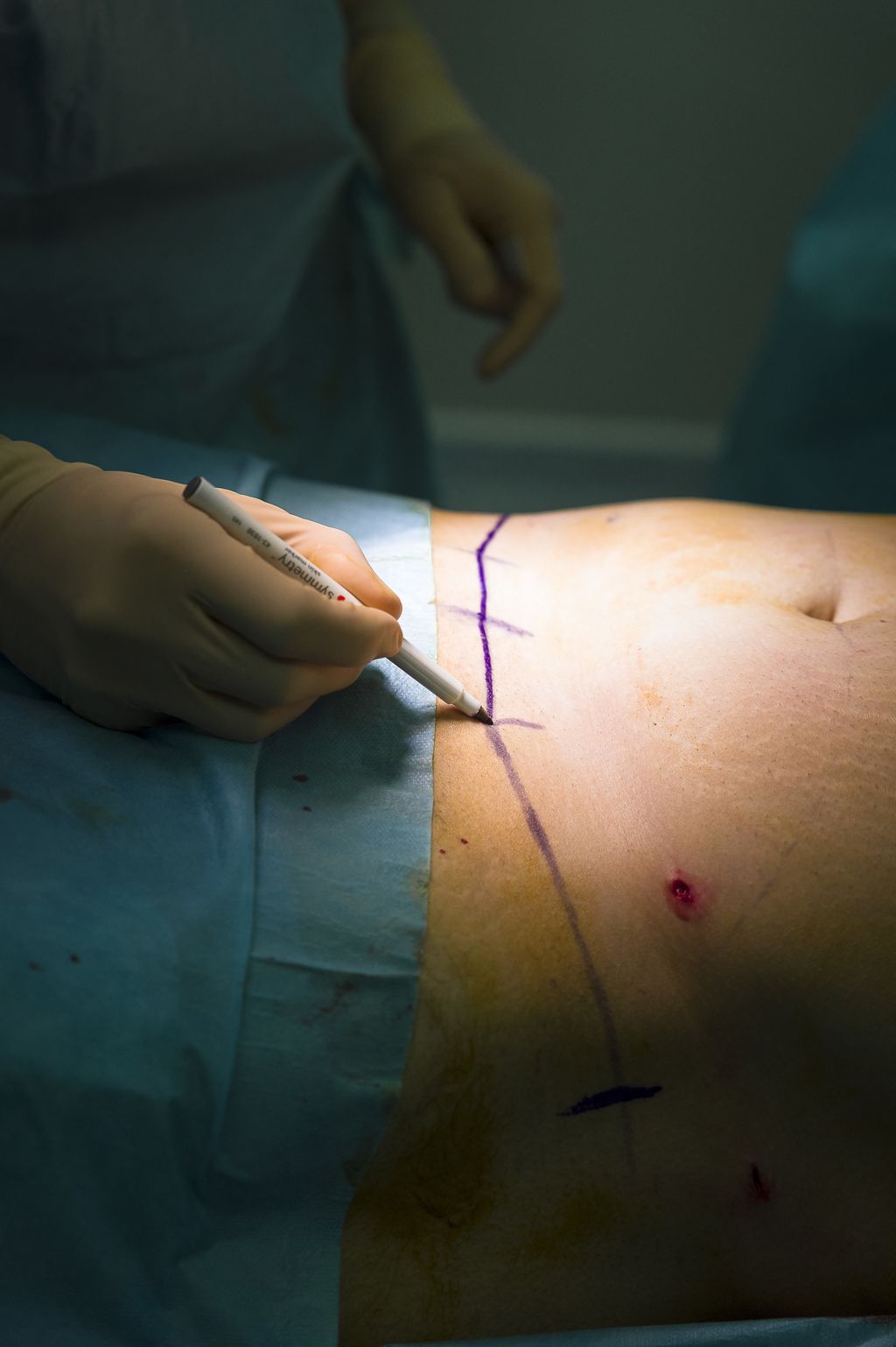 Operazione chirurgica, preparativi