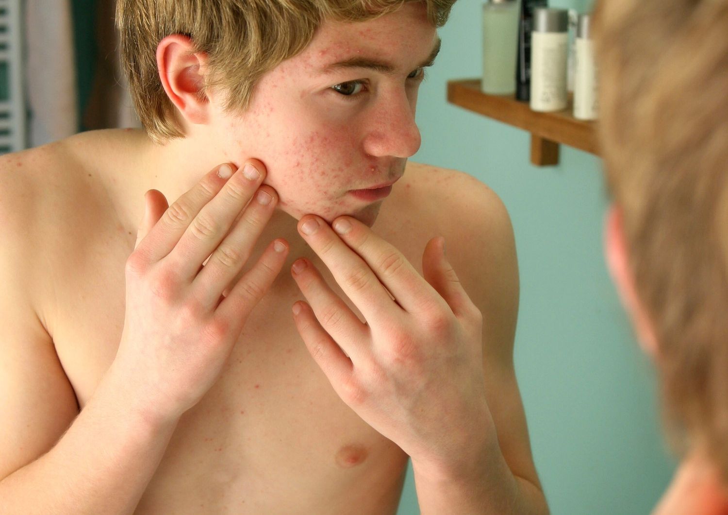 cura acne efficaci studio rivela