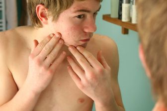 cura acne efficaci studio rivela